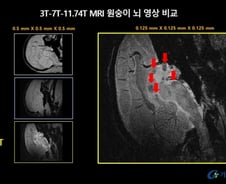 치매 유발 단백질, 3개만 쌓여도 MRI에 딱 보인다