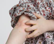 밤새 긁다가 피 봤다…아이들 '중증 아토피'  8년 새 2배 늘어