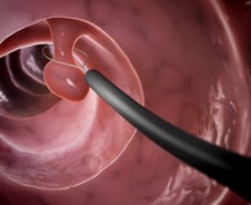 젊은 대장암 환자 사망 위험, '이 기술' 적용했더니 예측 정확도 90%