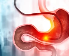 배 째야 하는 줄…한국인이 잘 걸리는 '위암' 효과적인 수술법은?