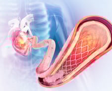 스텐트 시술받고도 심장병 재발하는 이유…韓 연구진 세계 최초로 밝혀