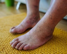 다리 절단까지 부르는 이 병…당뇨병 환자, 슬리퍼 조심해야 하는 이유