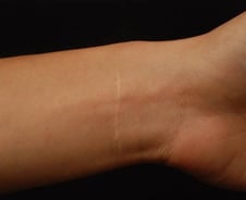 "성적 부담감이 너무 컸어요" 요즘 자해 청소년, 흉터 가리려 '이것'까지