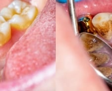 양치 살살해도 피나고 치아 '흔들'…잇몸에 달라붙은 '돌' 때문?