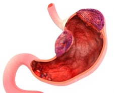 위내시경 검사받고 "종양입니다"…덜컥 겁부터 낼 필요 없는 이유