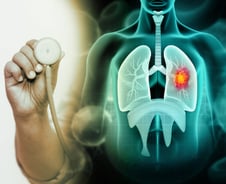 응급실서 폐암 놓쳐 '17억' 배상, 소송당사자는 외래 두 번 더 간 의사