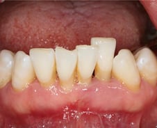 "웃겨도 못 웃어 슬퍼보여"…잇몸 내려앉아 웃지도 못하는 '이 병'