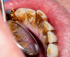 양치 살살해도 "피가 줄줄"…다닥다닥 붙은 '이것' 때문?