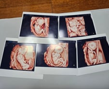 자연임신 다섯쌍둥이 국내 첫 분만 성공…"사전 시뮬레이션도 했다"