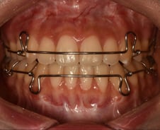 "돈 들였는데 치아 삐뚤빼뚤" 교정 후 '이것' 하면 원래대로 옵니다