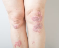 '건보 적용' 매일 먹는 건선 약, 한 번 맞는 주사보다 좋은 점은?