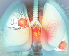 매일 1갑, 30년 흡연했어야 폐암 '국가검진'…환자 92% 수혜 못 받았다