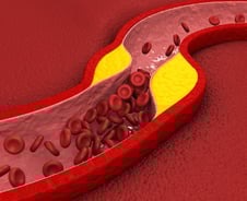 "LDL 콜레스테롤 낮추자" 바람 불더니…치료율 오르고 혈관질환 줄어