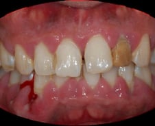 잇몸 무너지면 일상도 '와르르'…치매·골다공증 부른다