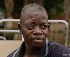 엠폭스 의심환자 느는데…비축한 백신 58% 유효기간 지났다