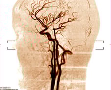 뇌혈관 터질까 전전긍긍…병력만 알아도, 정신질환 위험 높이는 '병'
