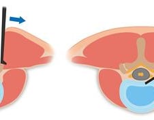 근육 벌려 뼈 깎는 수술도 옛말…당일 퇴원 가능한 척추병 새 치료법은