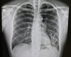 감기로 착각, 때 놓쳤다…"먹는 약도 소용 없어" 이 병 입원 10배 '쑥'