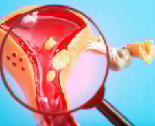 갑자기 심해진 생리통에 끙끙, 혹시 이 질환?…"임신 어려울 수도"