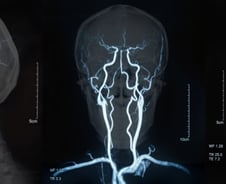 "골든타임 4.5시간"…아빠 말이 갑자기 어눌해졌다면 '이 증상' 의심을
