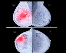 정부 연구기관 "유방암 수술 후 검사, 자주 받아도 생존율 큰 차이 없어"