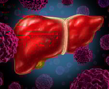 간암 부르는 지방간…매 끼니 적게 먹기? 살 쑥쑥 빠지는 '이 방법'