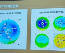 시력 1.5 되찾아 좋아했는데 '빛번짐'?…새 시력교정술 나왔다