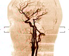 뇌경색 환자, 혈관 뚫은 뒤 '적극적인 혈압 조절' 더 안 좋아…왜?