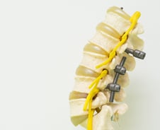 "허리 수술해도 아파" 3명 중 1명이 끙끙…S라인 지킬 '이 수술'이면 안심