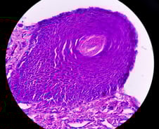 얼굴에 난 점, 점점 커지더니 암?… 눈 쌓인 날, 선크림 발라야 하는 이유
