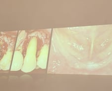 "나도 임플란트 했어"…한국인들 유독 수술 많이 하는 뜻밖의 이유