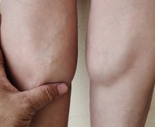 "아빠 종아리살이 쏙 빠졌네" 이 정도면 위험 신호…손가락 진단법