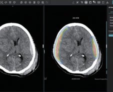 제이엘케이, 두개내출혈 검출 AI 솔루션 FDA 승인 획득