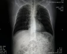 폐암 수술환자 10%에 숨어있던 '임파선 전이', CT로 예측한다
