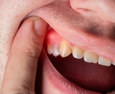 구석구석 '분노의 양치질'…나도 모르게 암 키웠다