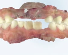 "와자작" 부럼 깨다 우리 아이 유치 '쏙'…"영구치 나잖아" 방심했다간