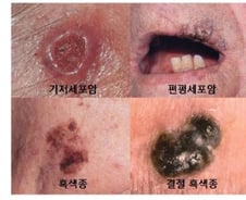 점 인줄 알았는데 암이라고?…꼭 체크해야 할 위험 신호 5개