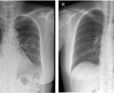 "적갈색 가래, 파란 입술 방치했다간…" 서희원 걸렸던 폐렴의 원인은?