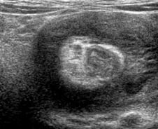 "아들, 감기 다 나았네" 한시름 놨는데…공포의 '장 도넛', 목숨도 위협?