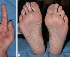 "성관계 후 걸렸어요"…일본서 폭증하더니 한국 덮친 '이 병'