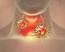 "지켜봅시다" 미세 갑상선암 불안했는데…"바늘 하나로 96% 없앴다"