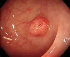 "용종 5개" 대장내시경 후 깜짝…최대 몇개까지 뗄 수 있을까?[한 장으로 보는 건강]