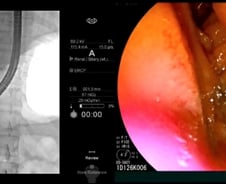 기름진 음식 먹고 명치 '쿡쿡', 황달까지…응급실 간 여성 몸속에 '이것'