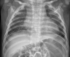100일 갓 지난 영아, 국내 첫 '신종 코로나'…폐렴·간 기능 이상 동반