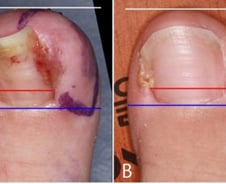 걸을 때마다 아프고 진물·고름…내성발톱, 안 뽑아도 된다