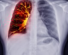 감기 아닌데 마른기침, 숨이 턱…"짧으면 3년 산다" 극악의 생존율 '이 병'