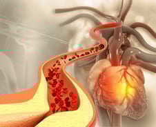 "윽, 가슴이" 최근 이런 통증이?…죽음 부르는 혈관 속 '덩어리'