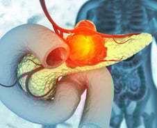 "수술 불가" 췌장암 환자에 '3000V' 전기 쐈더니…9개월 더 살았다