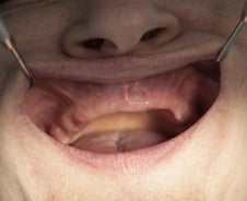 괜찮아지겠지…붓고 피 나는 잇몸 방치했다가 당뇨·뇌졸중까지