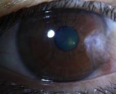 "충혈된 눈이 비상 신호였어" 각막 변형→건조증 악화…'이 병' 뭐길래